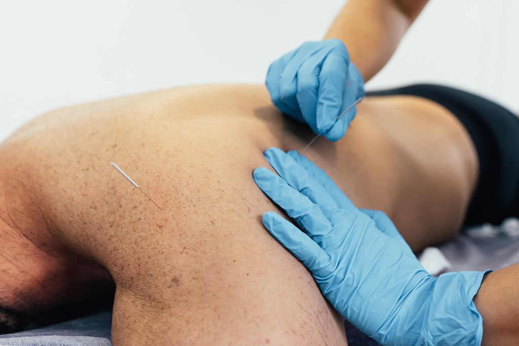 Dry Needling Acupuncture